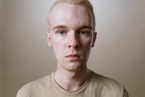 A close-up portrait of a blonde man with acne portraying a candid expression and natural look.